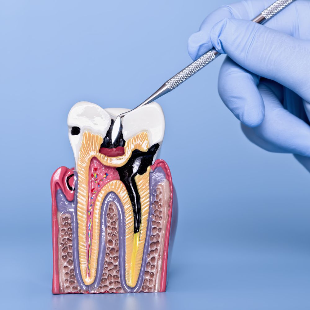 Periodontal Disease
