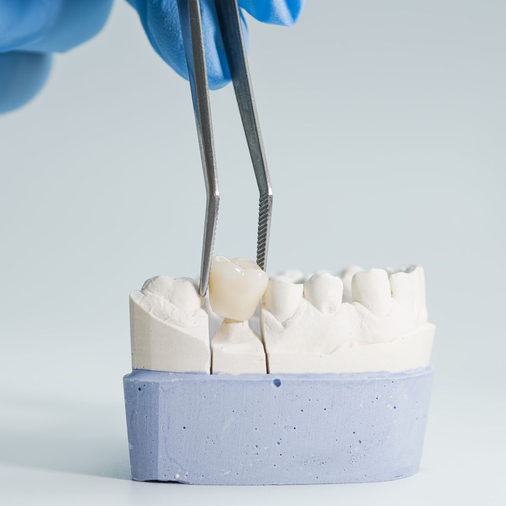 Porcelain Crowns (Caps)