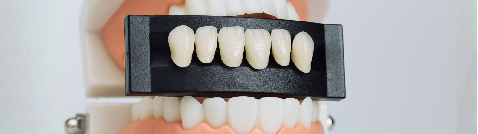 Porcelain Veneers