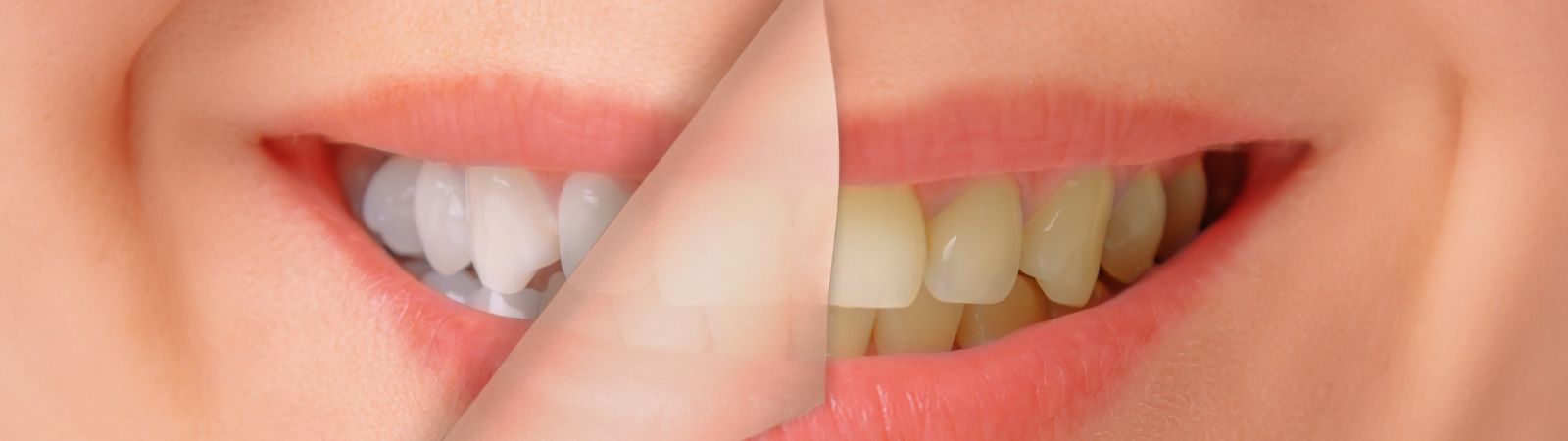 Teeth Whitening