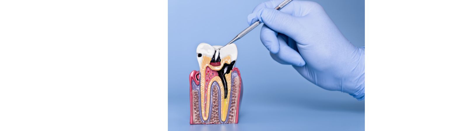 Periodontal Disease